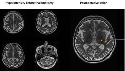 Making a Difference—Positive Effect of Unilateral VIM Gamma Knife Thalamotomy in the Therapy of Tremor in Fragile X-Associated Tremor/Ataxia Syndrome (FXTAS)